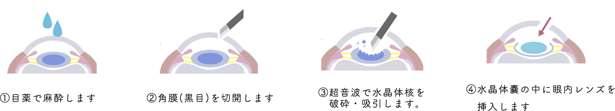 白内障手術のイメージ画像