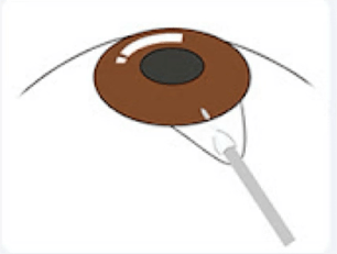 白目(結膜)の下に房水の流出路を作るイメージ画像