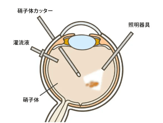 硝子体手術のイメージ画像