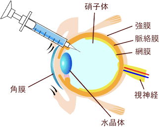 硝子体注射のイメージ画像