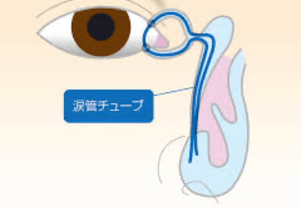 涙菅チューブ手術のイメージ画像