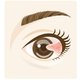 白目の結膜の増殖組織が角膜(黒目)に侵入するイメージ画像