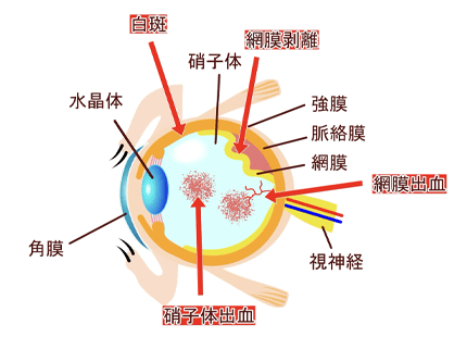 糖尿病網膜症のイメージ画像