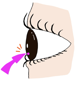 睫毛内反のイメージ画像