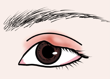 ものもらいのイメージ画像