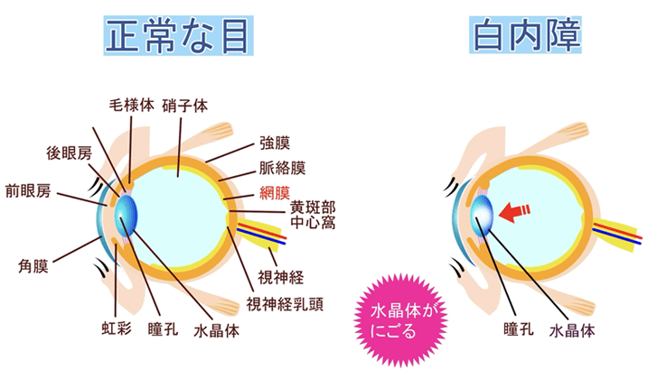 白内障のイメージ画像