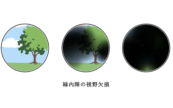 緑内障のイメージ画像