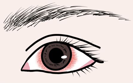 目が充血しているイメージ画像