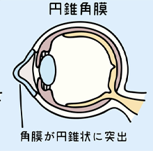 円錐角膜の治療のイメージ画像