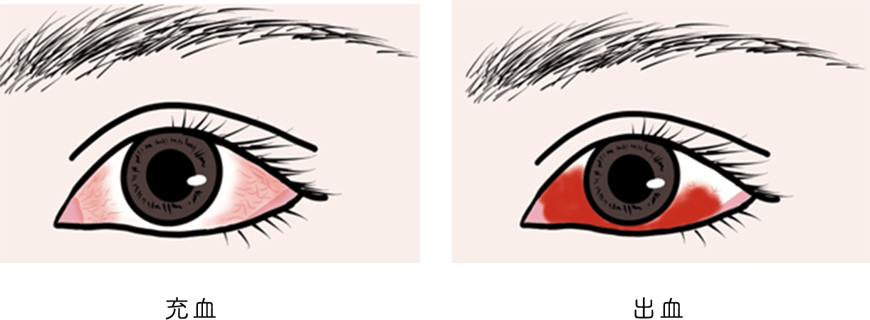 目が充血、出血しているイメージ画像