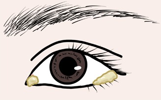 目やにが出るイメージ画像